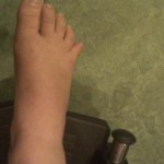 toe disclocation